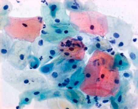 Papanicolaous Lösung 1a Harris Hämatoxylinlösung for cytology